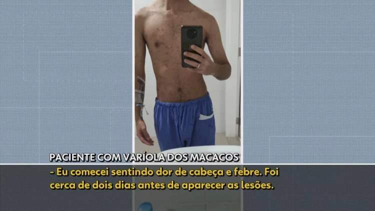 Jovem de SP com varíola dos macacos tem mais de 200 lesões no corpo